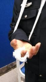 手砍伤图片,惊心动魄的急救纪实